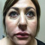 Women's Injectables Before & After Patient #3353