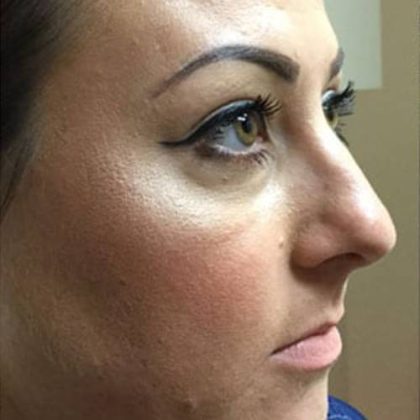 Women's Injectables Before & After Patient #3353
