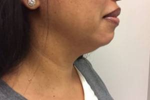 Women's Injectables Before & After Patient #3364