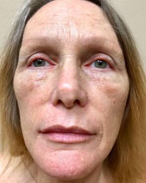 Women's Injectables Before & After Patient #3373