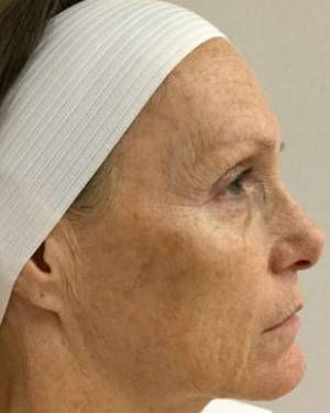 Women's Injectables Before & After Patient #3373