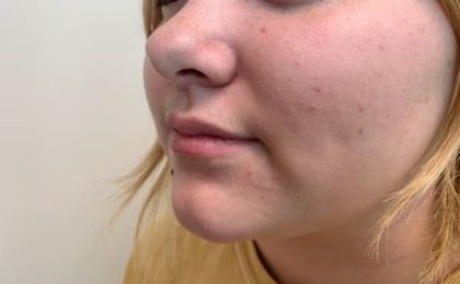 Women's Injectables Before & After Patient #3368
