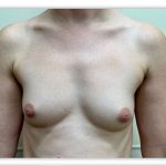 Breast Augmentation Before & After Patient #3604