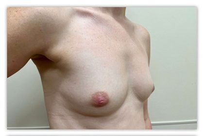 Breast Augmentation Before & After Patient #3604