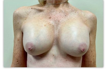 Breast Augmentation Before & After Patient #3605