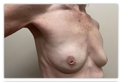Breast Augmentation Before & After Patient #3605