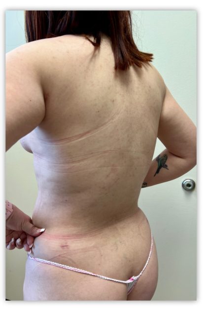 Liposuction Before & After Patient #3606