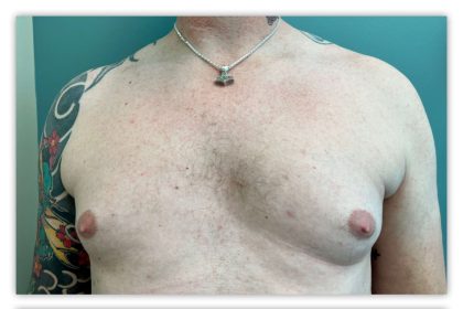 Liposuction Before & After Patient #3823