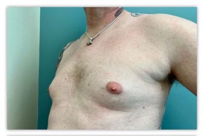 Liposuction Before & After Patient #3823