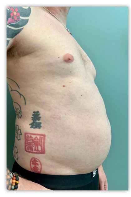 Tummy Tuck Before & After Patient #3607