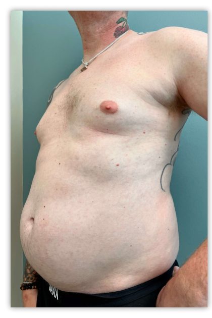 Tummy Tuck Before & After Patient #3607