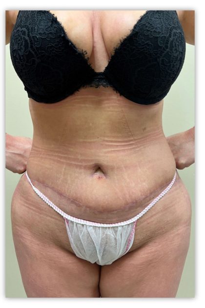 Tummy Tuck Before & After Patient #3609