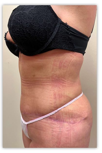 Tummy Tuck Before & After Patient #3609