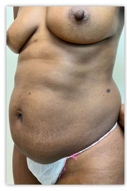 Tummy Tuck Before & After Patient #3610