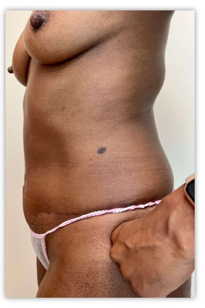 Tummy Tuck Before & After Patient #3610
