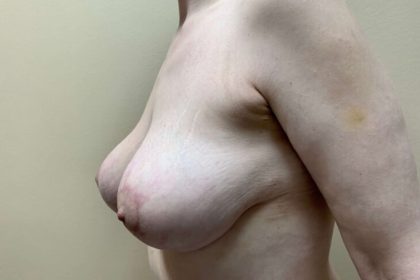 Breast Lift Before & After Patient #3863