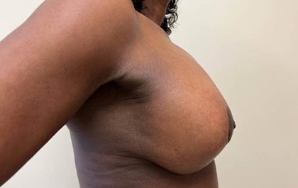 Breast Lift With Augmentation Before & After Patient #3925