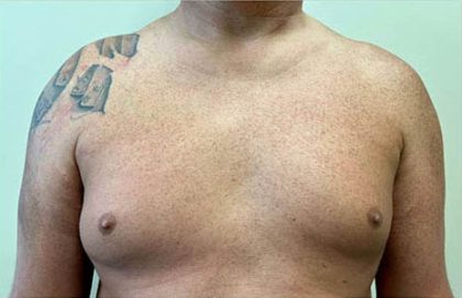 Liposuction Before & After Patient #3969