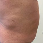 Liposuction Before & After Patient #3980