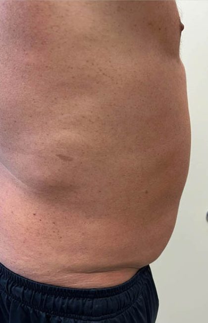 Liposuction Before & After Patient #3980