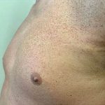 Liposuction Before & After Patient #3969