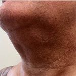 Neck Liposuction Before & After Patient #3958