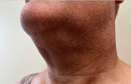Neck Liposuction Before & After Patient #3958