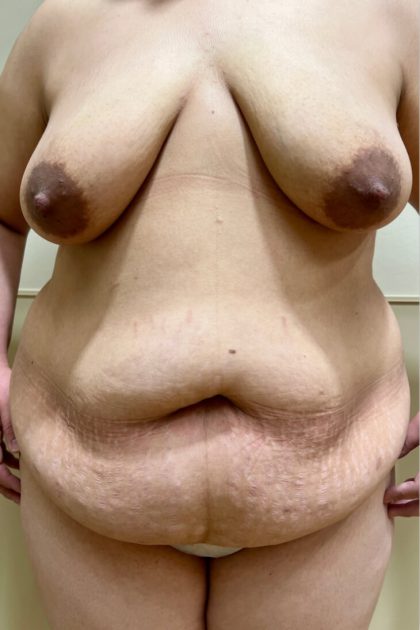 After Weight Loss Surgery Before & After Patient #3878
