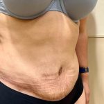 After Weight Loss Surgery Before & After Patient #4051