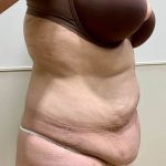 After Weight Loss Surgery Before & After Patient #4051
