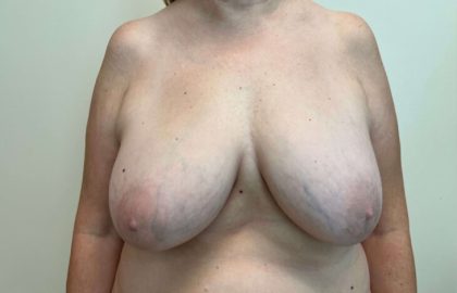 Breast Lift Before & After Patient #4034