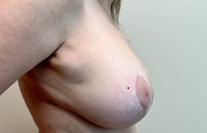 Breast Lift Before & After Patient #4034
