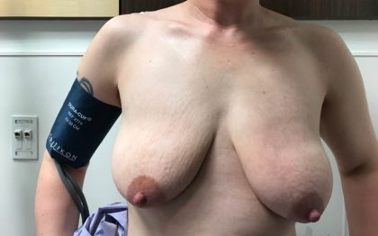 Breast Lift With Augmentation Before & After Patient #4125