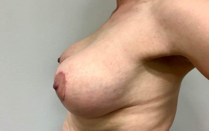 Breast Lift With Augmentation Before & After Patient #4125