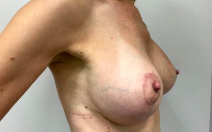 Breast Lift With Implant Exchange Before & After Patient #4136
