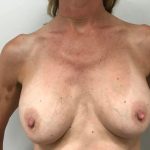 Breast Lift With Implant Exchange Before & After Patient #4136