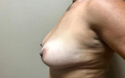 Breast Lift With Augmentation Before & After Patient #4114