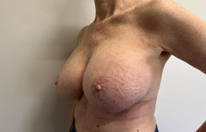 Breast Implant Removal and Replacement Before & After Patient #4168