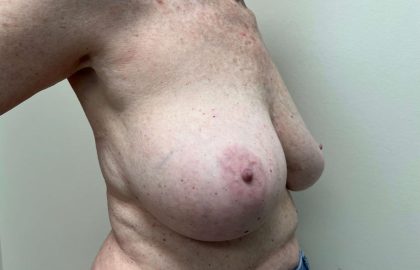 Breast Implant Removal and Replacement Before & After Patient #4168